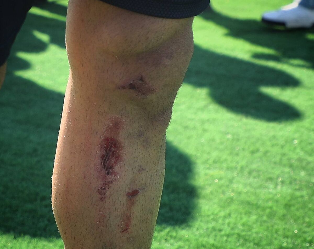 خبر نگران کننده برای پرسپولیسی‌ها | علیرضا بیرانوند مصدوم شد ؟