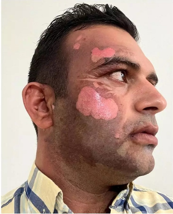 شکارچی غیرمجاز محیط‌بان را سوزاند اما از زندان آزاد شد + عکس