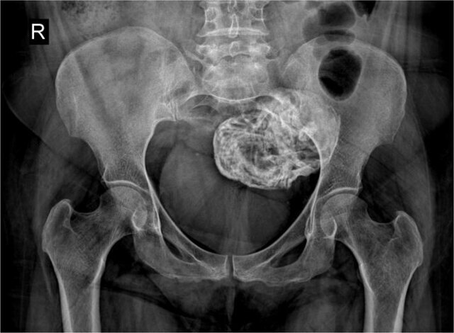 یک زن ایرانی در رحم خود جنین سنگی داشت + عکس