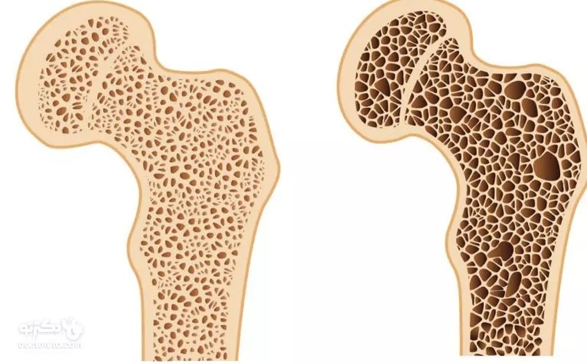 موثرترین راه برای پیشگیری از ابتلا به پوکی استخوان
