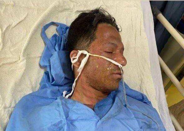 عکس | تصویری دلخراش از سوختگی زیاد بازیکن سابق پرسپولیس