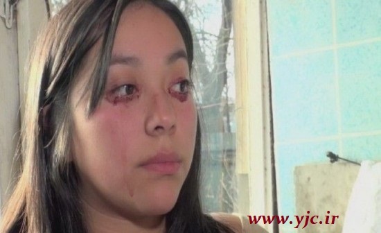 عکس | تصویری عجیب اما واقعی از دختری که خون گریه می‌کند!