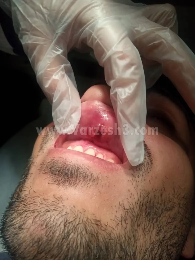 عکس | کتک کاری در زمین فوتبال! | مدافع استقلالی به اتاق عمل رفت!