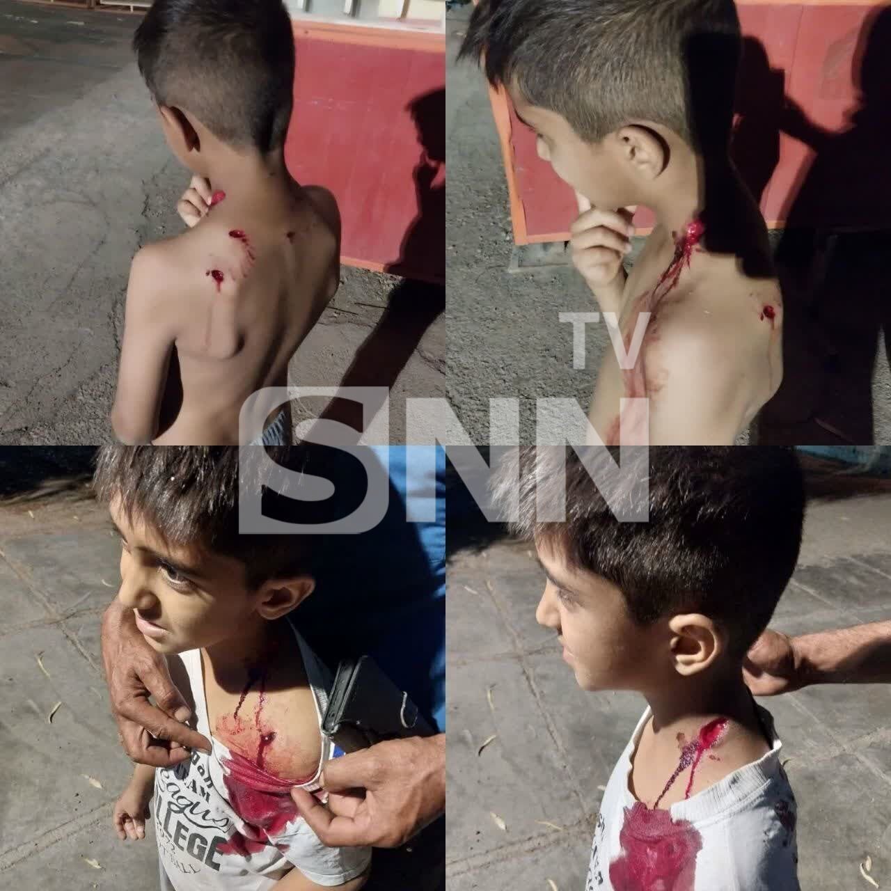 سگ ولگرد در این شهر حادثه آفرین شد | تصویر گازگرفتگی یک دانش آموز