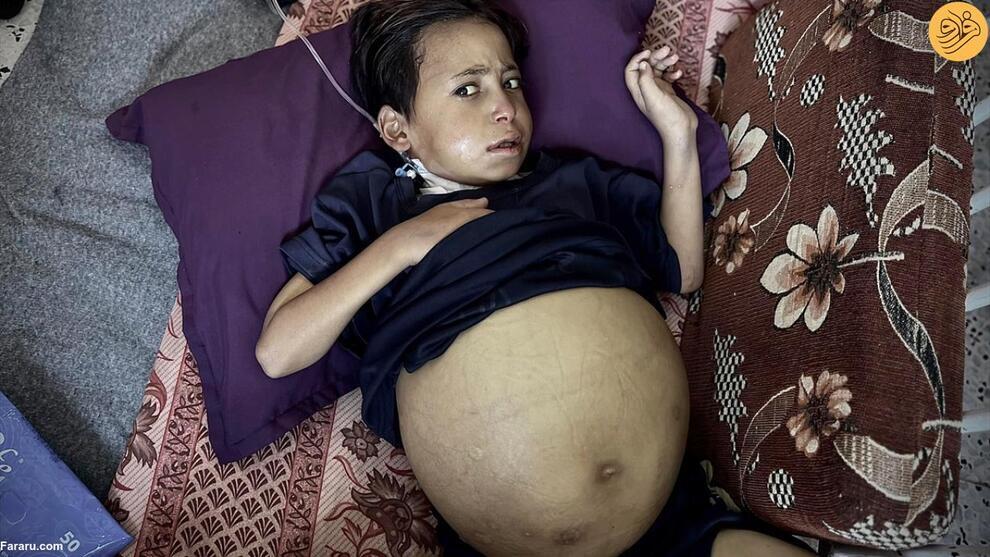 عکس | شکم غیرعادی و بزرگ کودک فلسطینی او را از پا انداخته! عکس | شکم غیرعادی و بزرگ کودک فلسطینی او را از پا انداخته!