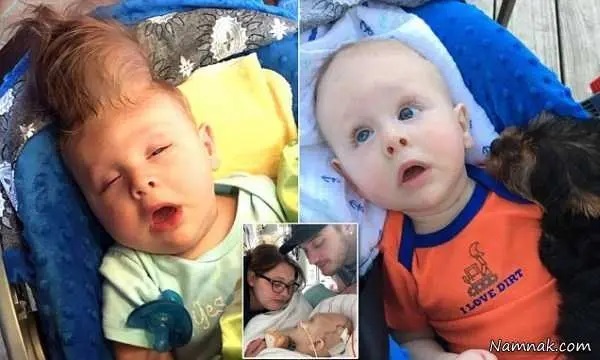 عکس | نوزادی که مغزش بیرون از سرش بود عمل شد!
