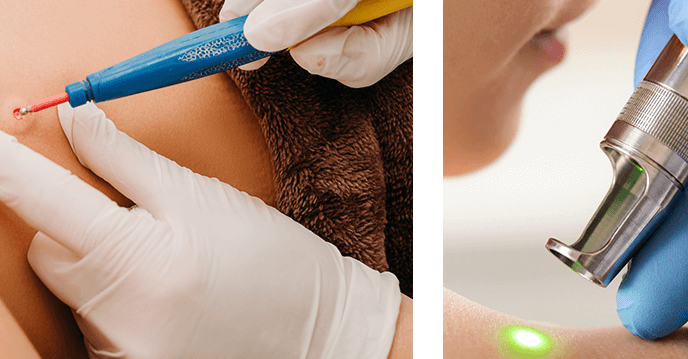 درمان زگیل تناسلی؛ بررسی هزینه‌ها برای رهایی از HPV