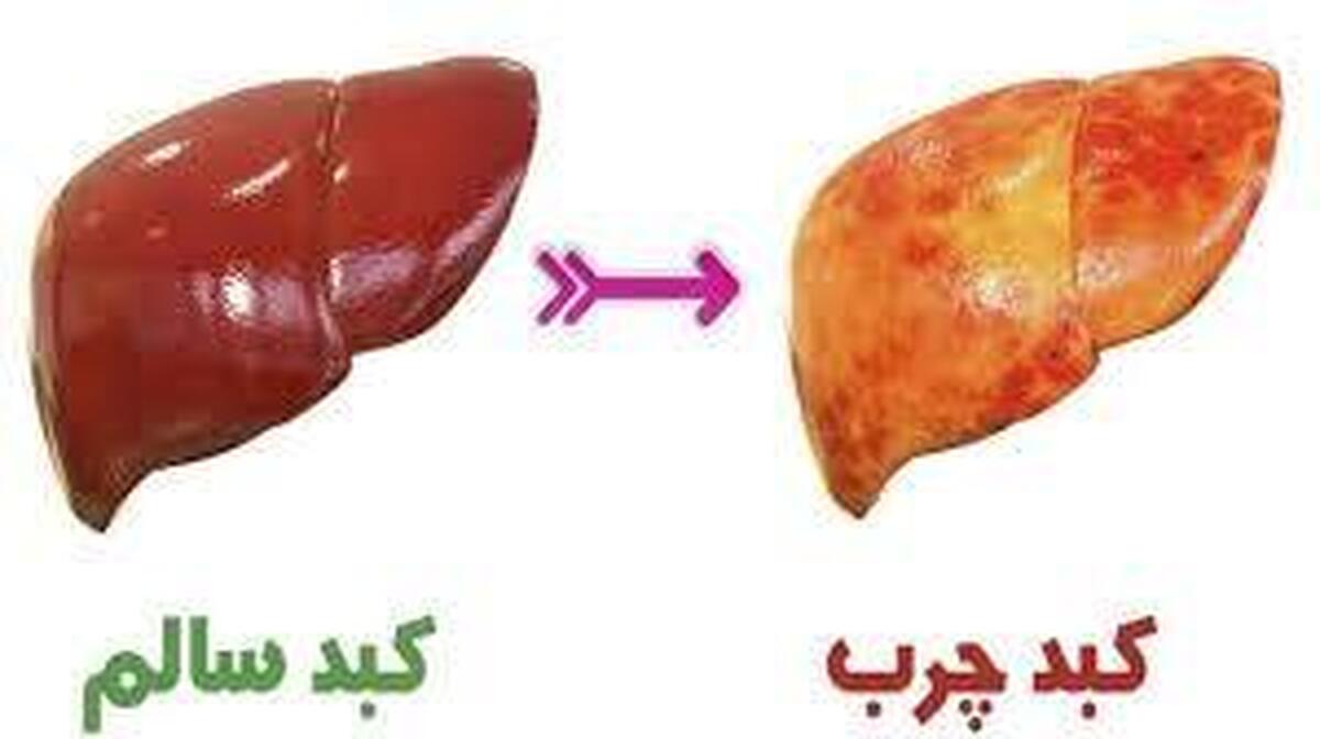 این ویتامین‌ها قاتل کبد چرب هستند