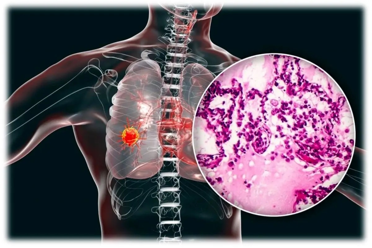 با این تست ۵ ثانیه‌ای سرطان ریه را تشخیص بدهید!