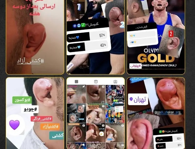 عکس جراحی گوش مدل حسن یزدانی چقدر هزینه دارد؟!