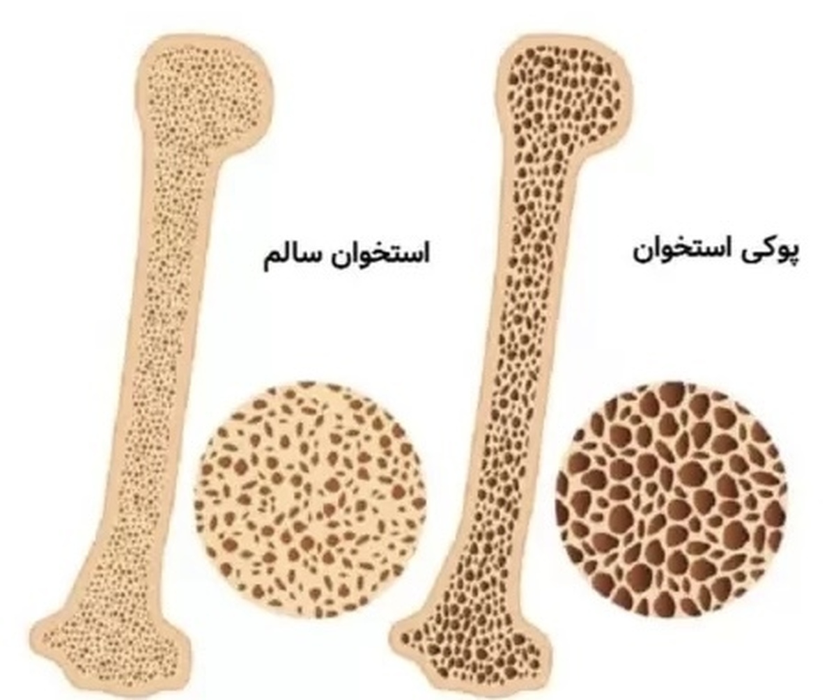 چطور از پوکی استخوان پیشگیری کنیم ؟