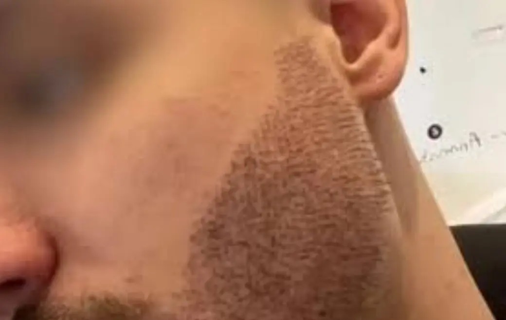 خودکشی پسر جوان به دلیل کاشت ریشی که خوب از آب درنیامد!