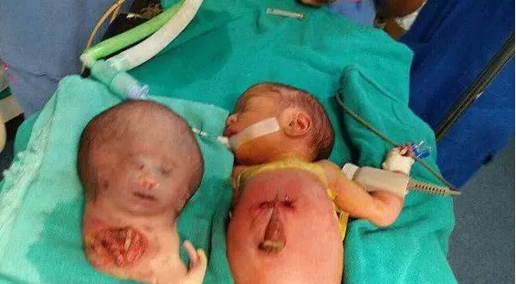 عکس | نوزاد دو سر جراحی شد! | این عکس را نبینید بهتر است! عکس | نوزاد دو سر جراحی شد! | این عکس را نبینید بهتر است!