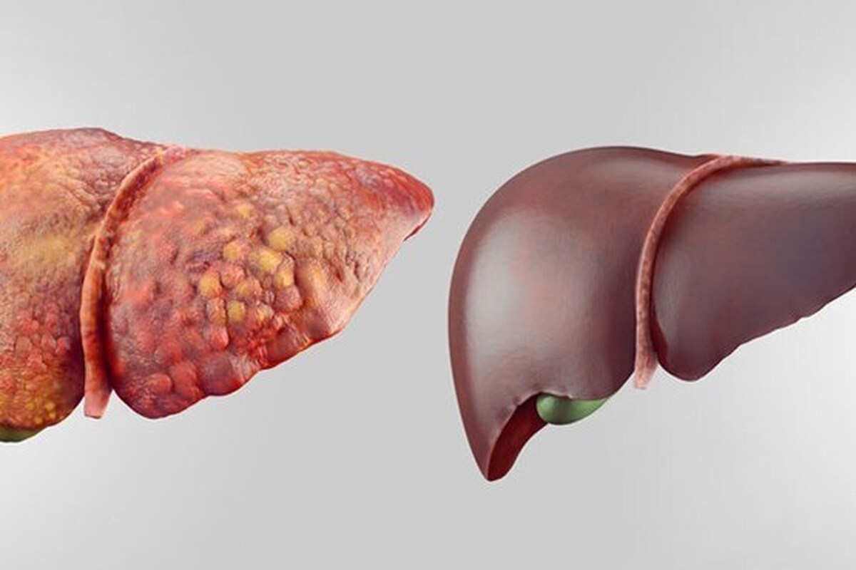 این مواد غذایی کبد چرب را درمان می‌کنند