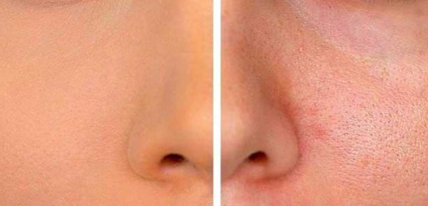 چگونه پوستی صاف و بدون منافذ داشته باشیم؟ 5 نکته طلایی مراقبت از پوست